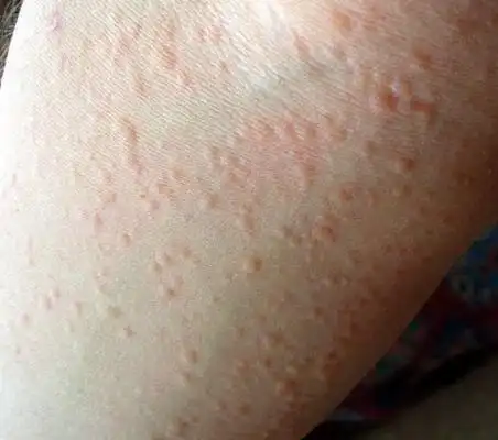 风疙瘩图片 (20)