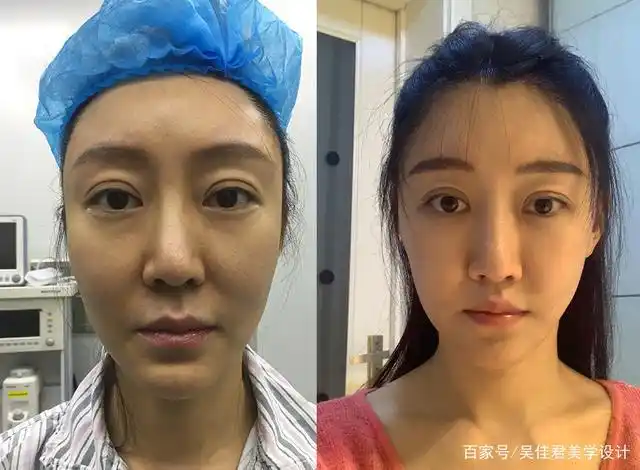 不知不觉,做完小拉皮手术已经4个月了.