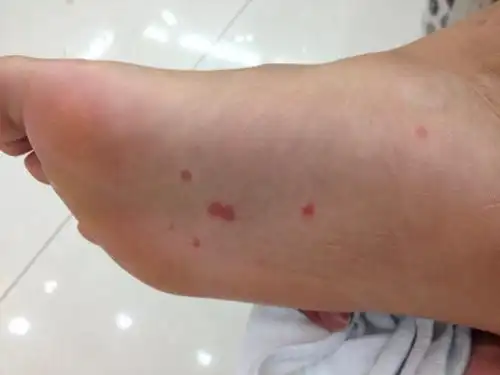 脚上莫名的起了这些红点,不疼不痒怎么回事?