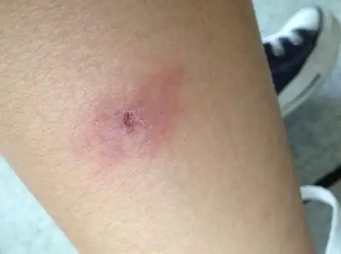 床虱咬到人的皮肤图片,床虱一般藏在哪里?