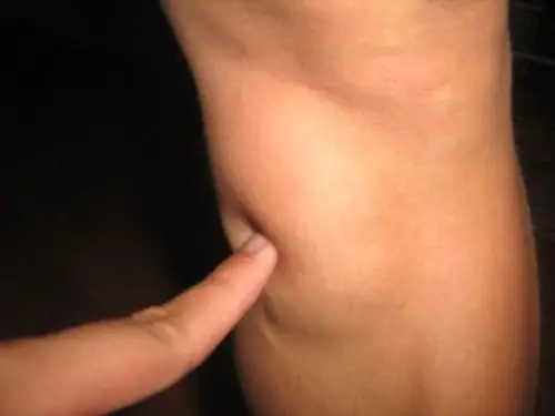 关于腿上长了一个包