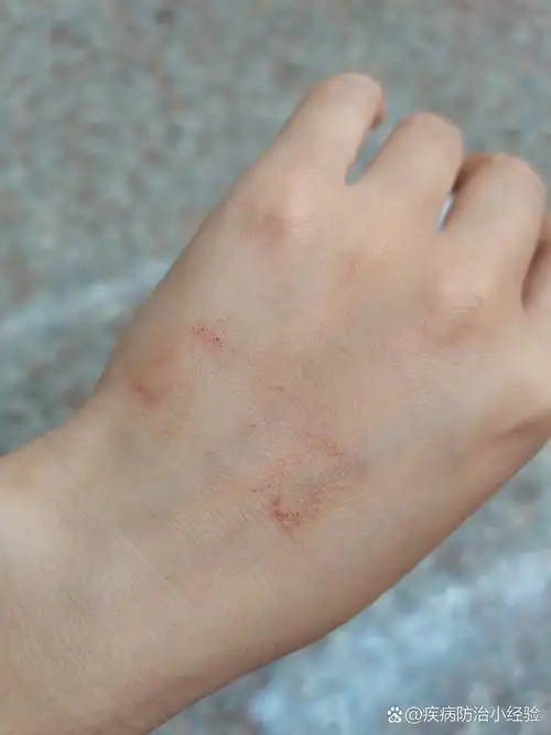 下手太重了,拔了针后都漫血了0303