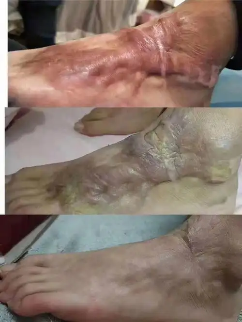 双脚严重烧伤修复全过程