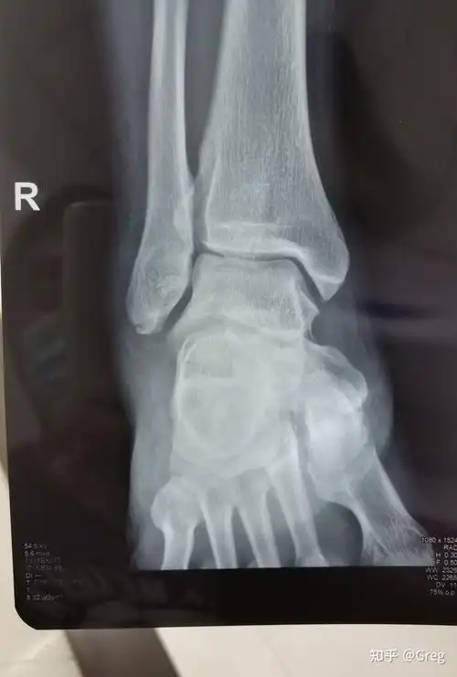 右脚踝撕脱性骨折