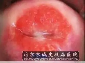 淋病患者要注意哪些事项