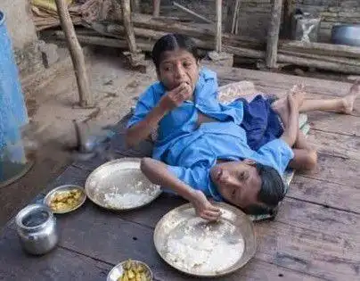 印度连体兄弟头部连在一起日常生活怎样想分离吗