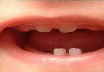 婴儿从几个月开始用布擦牙龈