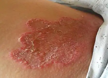 长沙鸿业皮肤医院:怎么判断是阴囊湿疹还是股癣?_疾病_细菌_因为