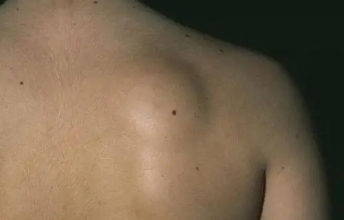 同济科普 | "富贵包"可能是脂肪瘤!减肥,抽脂都没用?