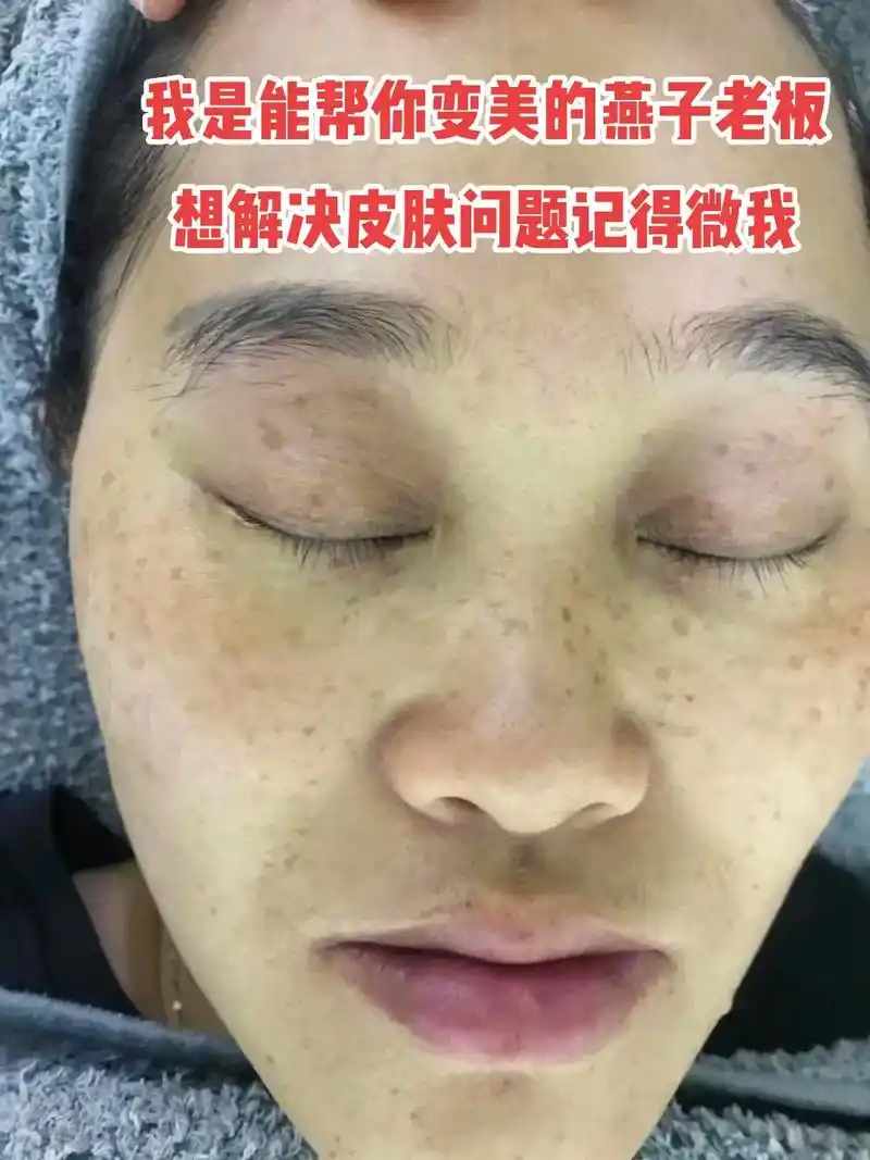 燕子老板专业专心解决你的皮肤问题为你的美丽容颜保驾护航现在祛斑有