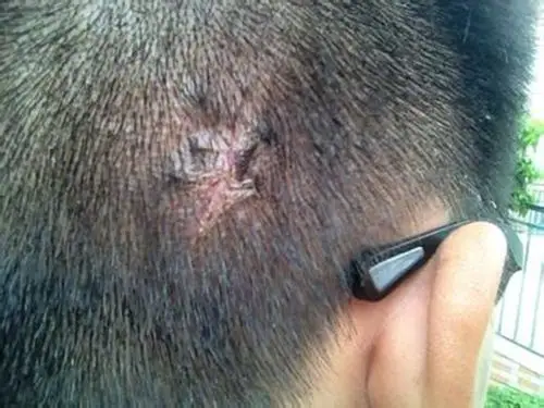 手臂皮下脂肪瘤图片