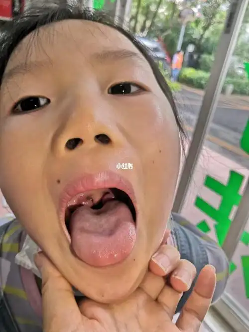 78【腺样体肥产大69生的原因】 当69孩子闭不嘴上69,白天