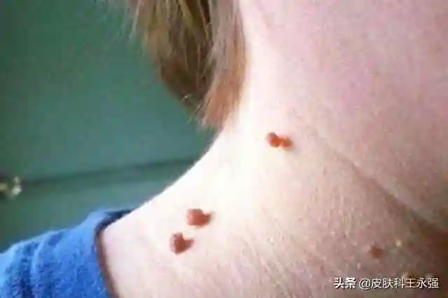 脖子上长小肉粒是什么原因初期脖子小疣体图片