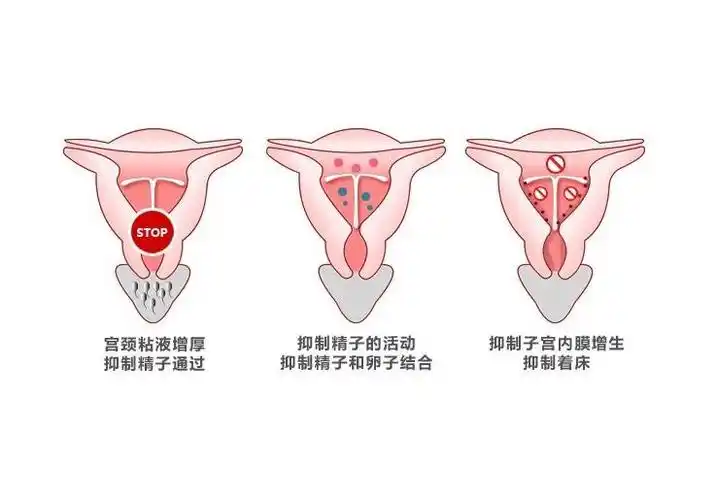 节育环中的曼月乐环能用多久价格贵不贵