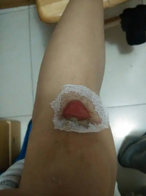 腿磕成这样了,多久能结痂?多久好?伤口和纱布粘在一起了