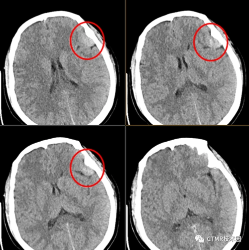 【ct技术】脂肪瘤/脑膜瘤/重建算法与显示窗宽窗位/扫描视野与重建