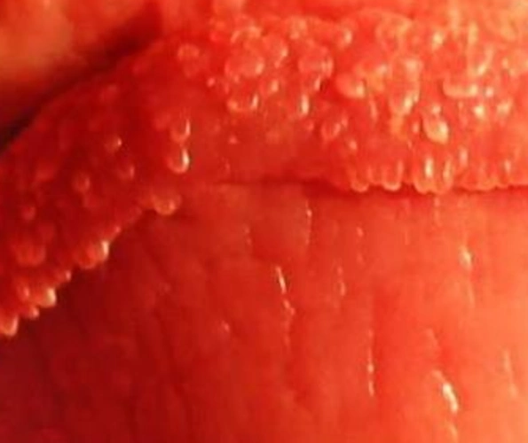 图木舒克包皮龟头炎医院_图木舒克治疗包皮龟头炎哪家医院好_图木舒克