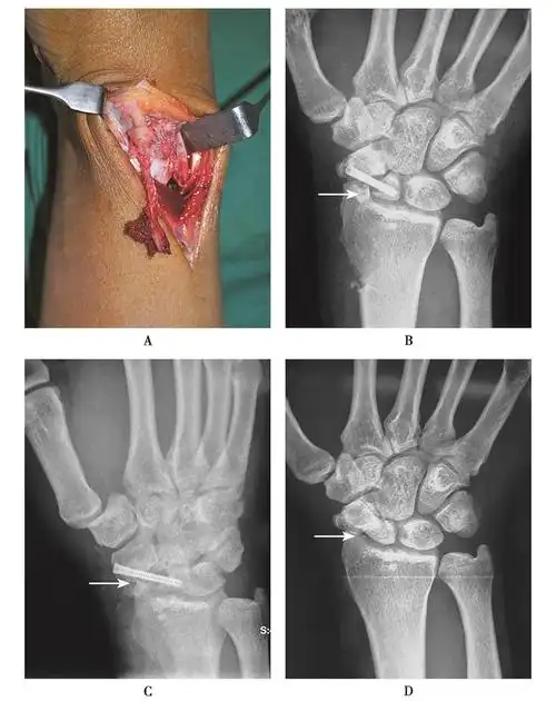 植骨位置不当及herbert钉内固定;d.舟骨骨折愈合后,植骨块突出舟骨外