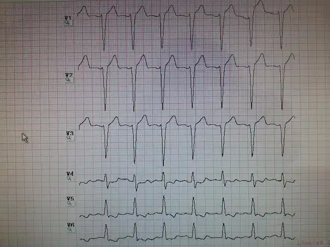 这是不是完全性左束支传导阻滞