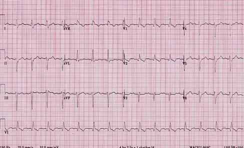 窦房传导阻滞的鉴别诊断