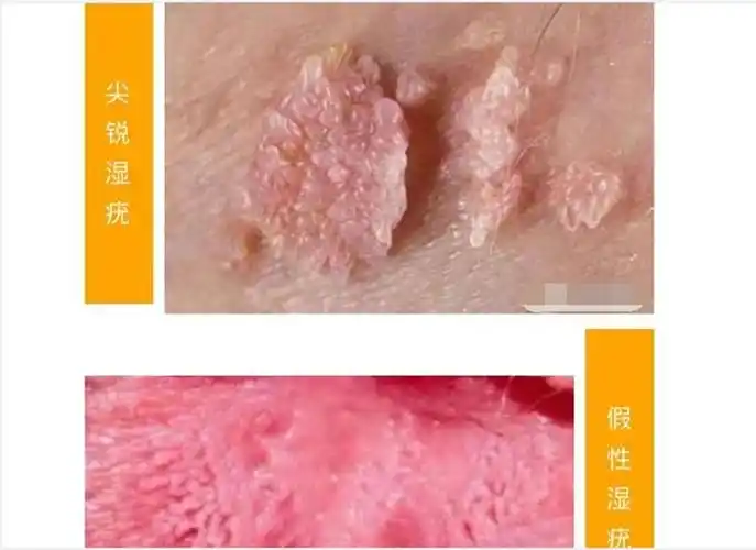 早期假性湿疣图片_有来医生
