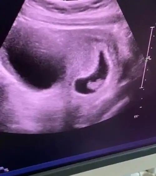 孕8周的孕囊,这是什么形状啊,都说茄子和长条大多是_妈妈网孕育社区