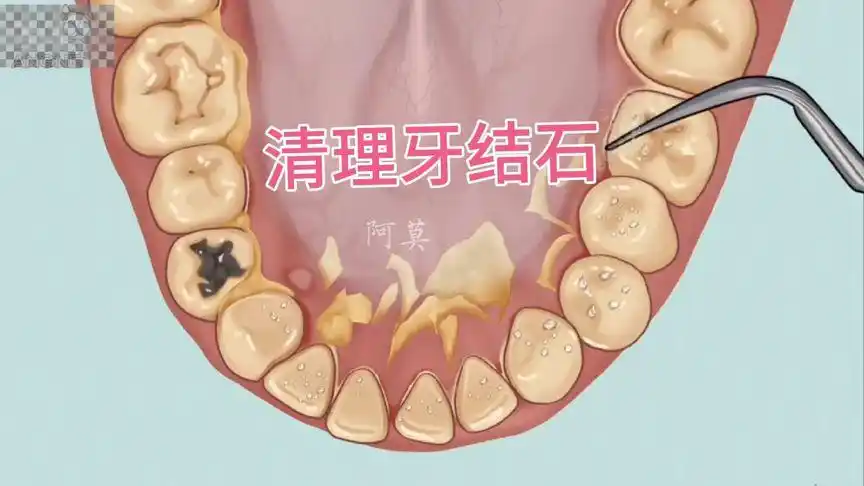 牙结石清理,大块的黄色污渍清除,过程解压舒适