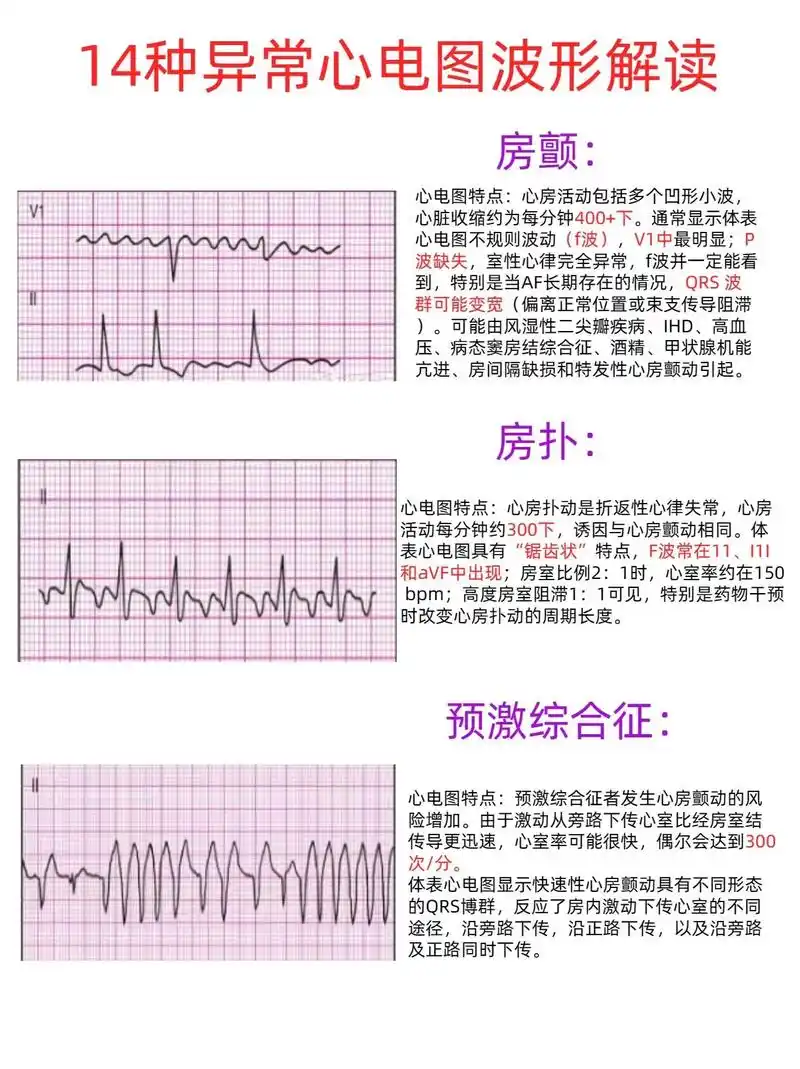 心电图波形解读,记得收藏哦#主管护师 #护师 #护士懂护士  - 抖音