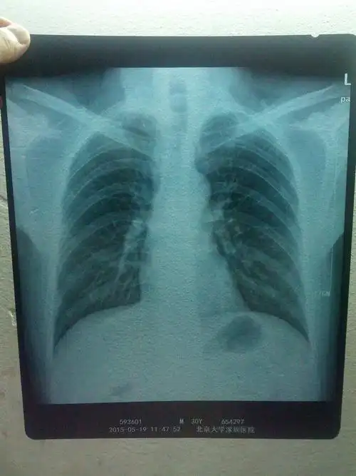 健康问题:x光的拍片有谁看得懂,帮看下到底是什么情况,谢谢了