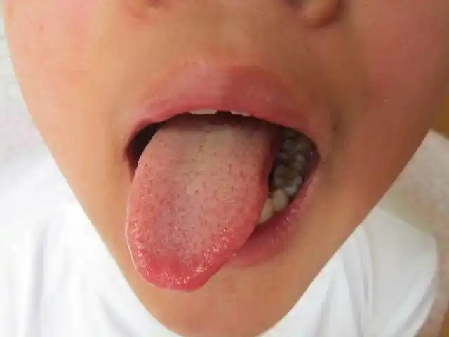 在孩子出现积食症的早期,舌苔不会有任何改变,但随着时间的推移,孩子