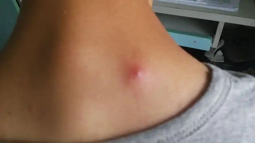最近我颈部突然出现红肿,起了一个小包,最近看网上好多人被蜱虫咬了