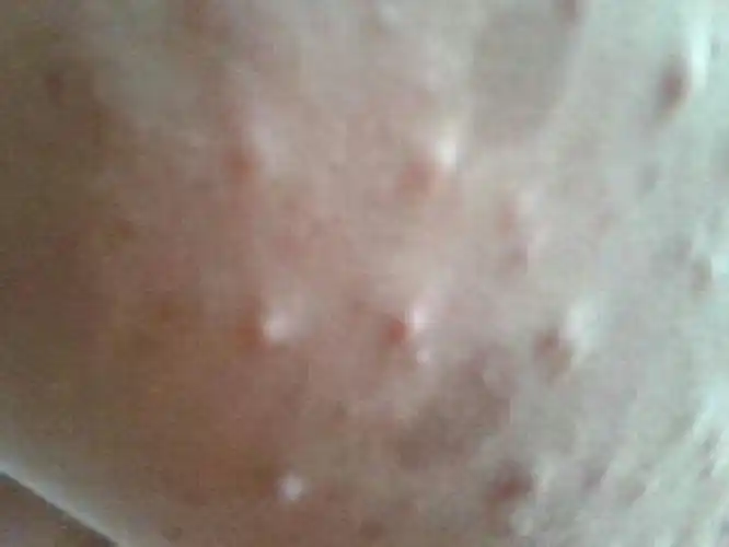 肚子上长脂肪瘤图片