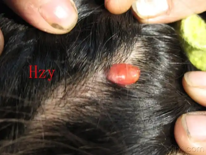 头皮上生了个小东西公布答案化脓性肉芽肿
