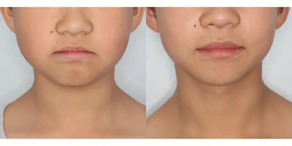 早期地包天的解除上颌发育不足的改善