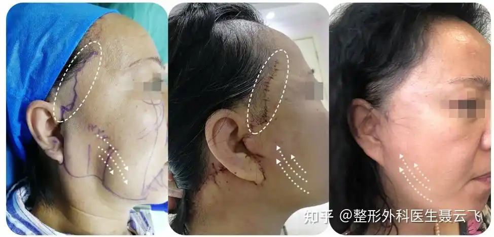 医生用真实案例告诉你:拉皮手术切口从上到下这样分 - 知乎