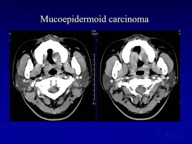 颌面部解剖及其病变的影像诊断