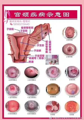 宫颈糜烂的女性白带多肚子疼