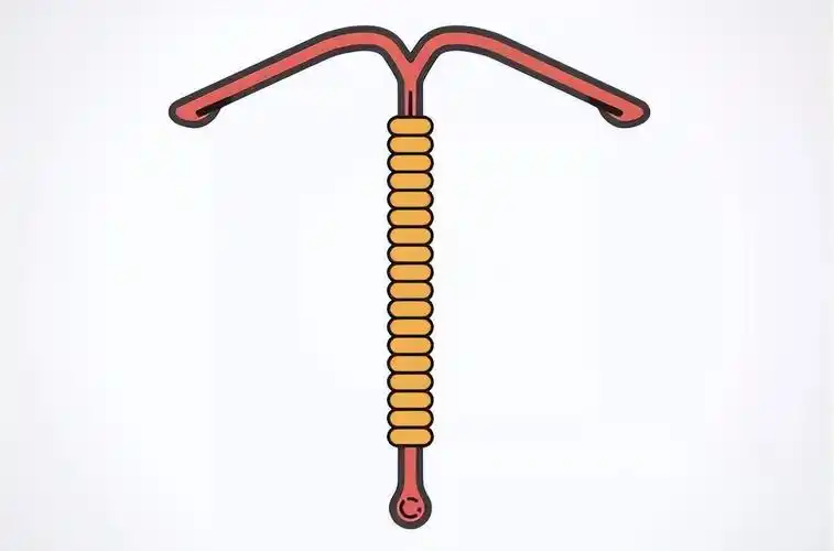 医生提醒:最佳取环年龄别超这一数