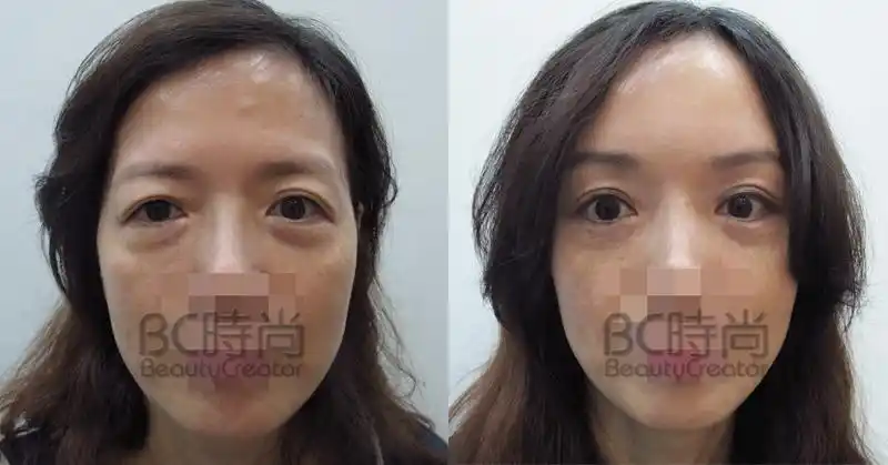 拉皮_内视镜上额提眉拉皮手术(并前额骨瘤磨平及整形胶的应用)