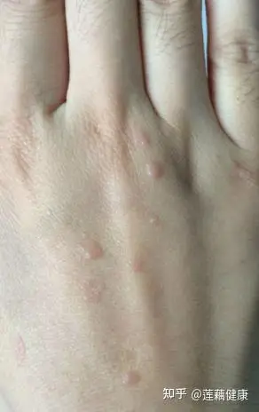 24岁女患者,手背长"小点点",越扣还越多,原来是扁平疣在作怪 - 知乎