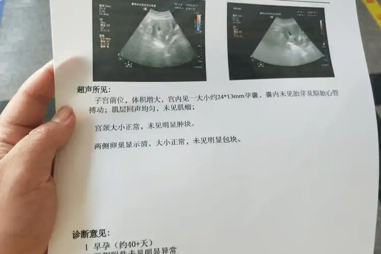 通常胎囊在5周出现,胎心在7周出现.