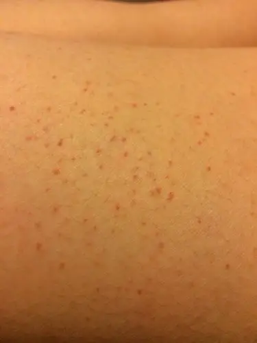 身上出现了红色斑点,皮下的出血小点点,不痛不痒,多处四肢和身上,是