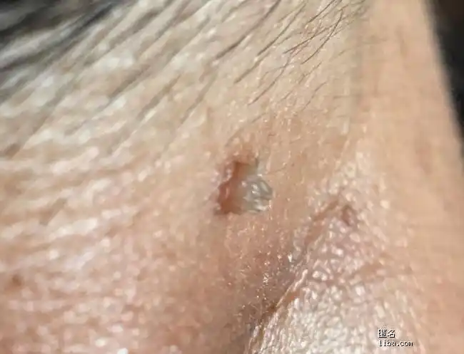 眼角上长了个凸起脂肪瘤有图慎入