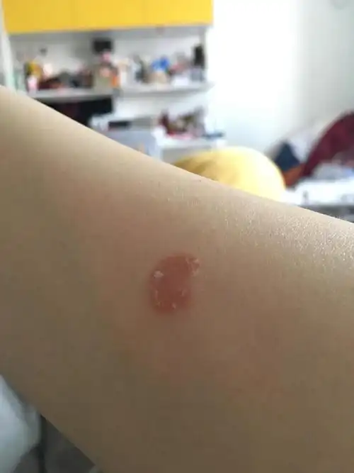 我这长得是猫藓吗?