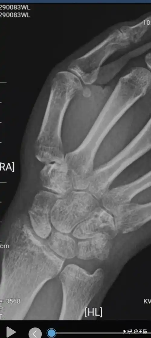 舟骨骨折恢复过程