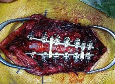 为什么腰椎手术后仍感疼痛腰椎内固定手术