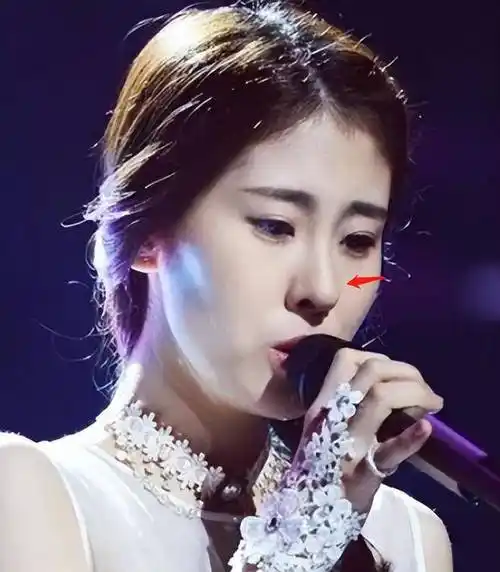 张碧晨疑似整容,嘴歪脸斜鼻孔外翻,网友直呼像牛魔王!_鼻子_大小_时候