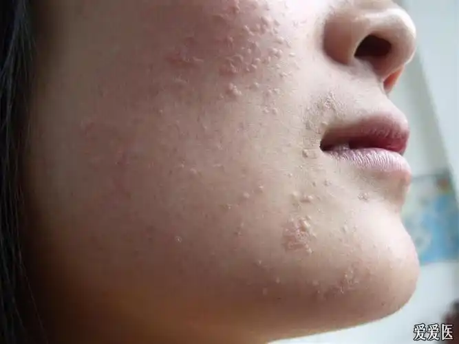 扁平疣治疗经过 - 皮肤及性传播疾病讨论版 - 爱爱医医学论坛 - 爱爱