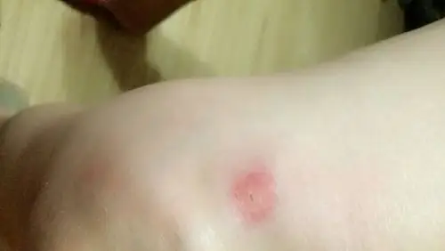 这是什么虫子咬的,特别痒,而且有点发烫