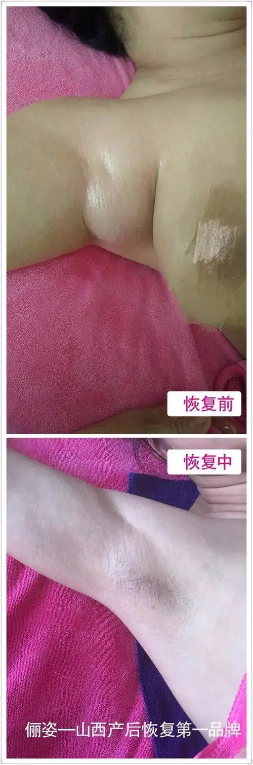 产后长"副乳"要割吗?二胎宝妈证明这样做不用手术,奶水还更好!